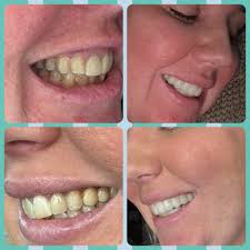 Risks associated with dental crowns