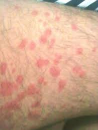 Allergic Reaction Black Ant Bites Pictures Dust Mite Rash Dust Mites Bites Dust Mite Allergy Dry Skin Patches