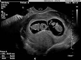 Just graduated after dealing with preeclampsia and delivering at 34 weeks. Diagnostic Ultrasound In The First Trimester Of Pregnancy Glowm