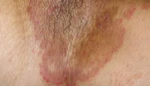 Image result for penis mycosis symptoms