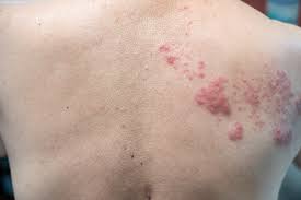 Image result for herpes zoster