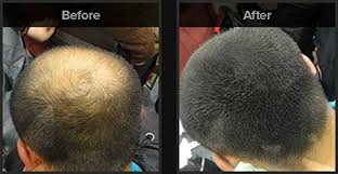 Medications like minoxidil and finasteride have been shown to slow down the. Fix O Fit Hair Building Fibers Light Brown Hair Loss Concealer Fibers To Conceal Thinning Hair And Add Volume For Both Men And Women 12 Day Supply Buy Online In