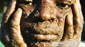 Monkeypox typically presents clinically with fever, rash and swollen lymph nodes. Two Confirmed Cases Of Monkey Pox In Liberia Since 1970 Not Four As Reported Frontpageafrica