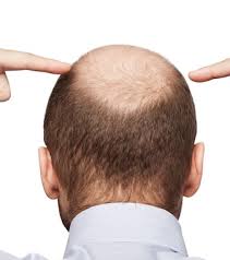 8 (dht stands for dihydrotestosterone, a hormone that has been linked to hair loss. Mq9pv5rdgf3xsm