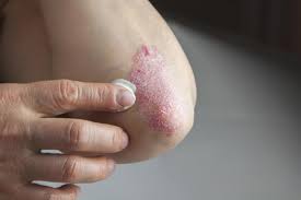 Some use eczema to refer to atopic dermatitis, while others use the term as an umbrella for all kinds of dermatitis and skin disorders. Marijuana May Help Cure Eczema According To Researchers The Independent The Independent