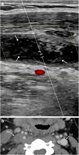 In 1938, fischer published a seminal paper describing five segments of the ica that were designated c1 through c5. Pathology Of The Carotid Space Insights Into Imaging Full Text