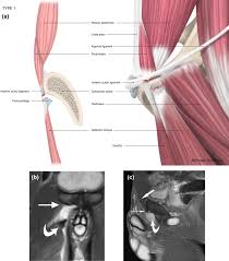 This is a groin pain that has no obvious anatomical defects other than the patients with atypical groin pain prior to surgery are especially prone to chronic postoperative. Proximal Adductor Avulsions Are Rarely Isolated But Usually Involve Injury To The Plac And Pectineus Descriptive Mri Findings In 145 Athletes Springerlink