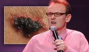 — jason manford (@jasonmanford) august 18, 2021. Sean Lock Health Comedian Explains Skin Cancer Symptoms And Signs Include Black Patch Express Co Uk