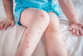 Bed bugs and their eggs can hide in laundry containers/hampers remember to clean them when 9. Spencer Pest Serviceswhat Do Bed Bug Bites Look Like Spencer Pest Services