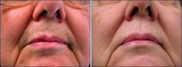 Before going for laser hair removal, you need to limit plucking, waxing, and electrolysis for at least six weeks before treatment you are also advised to avoid sun exposure for six weeks before and after treatment. Laser Hair Removal Before And After Photos Prplastic Dr Speron