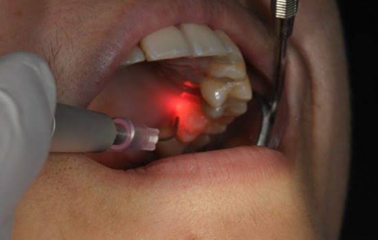 Laser treatment care 2