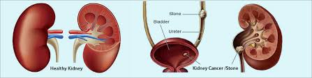 Best Kidney Stone Surgery By Urologist In Kolkata Dr Kalyan Kumar Sarkar Best Urological Surgeon In Kolkata India