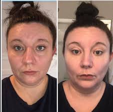 My skin care treatment by Mum #lillytheteenager