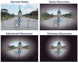 Glaucoma is the second leading cause of blindness. Glaucoma How Not To Go Blind Let S Talk About The Treatment Klinika Oftalmologii Doktora Shilovoj Corporate Blog Habr