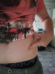 Knubbel Im Bauch Was Kann Das Sein Gesundheit Und Medizin Knoten Lipom