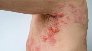 Image result for shingles