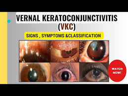 Image result for Vernal Conjunctivitis