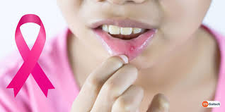 Dentists and dental hygienists are usually the first to notice the beginning signs of hard palate cancer during their routine exams. Mouth Cancer Stages Symptoms Causes Treatment Gomedii