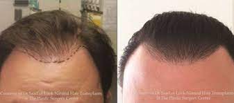 At avanta, hair transplants are done by akaki tsilosani, md, phd. Neograft Hair Transplants In Gainesville Fl