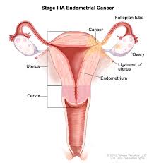Endometrial Cancer Treatment Pdq Patients Oncolink