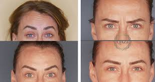 Some people experience a mild headache following an injection into the muscles in the forehead. Are You Complaining Botox Didn T Work On Me Qazi Clinic Irvine Ca