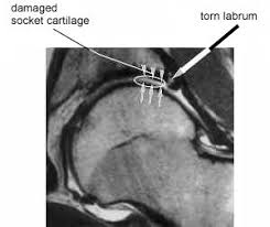 Femoroacetabular Impingement A Patient S Guide To Hip Mobility And Hip Arthroscopy Hip Surgery Recovery Impingement Hip Arthroscopy