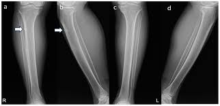 Image result for Tibia Stress Fracture
