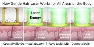 Essentially, electrolysis works by disrupting all hair growth, says thurman: Laser Hair Removal Coastal Valley Dermatology
