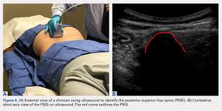Selamat datang ke laman web rasmi politeknik sultan idris shah klik disini untuk melayari laman web rasmi psis versi lama atau tunggu seketika untuk ke melayari laman web rasmi psis versi baharu. An Mri Analysis Of The Pelvis To Determine The Ideal Method For Ultrasound Guided Bone Marrow Aspiration From The Iliac Crest Mdedge Surgery