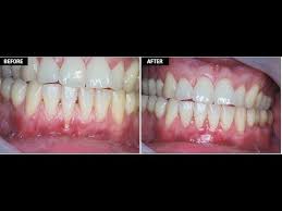 Reverses early gum damage · dentist recommended Natural Remedies To Reverse Receding Gum Line From Getting Worse Gum Health Gum Disease Treatment Gum Treatment