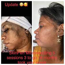 B A My Microneedling Journey Update Photo Hyperpigmentation And Severe Acne Scarring Skincareaddiction