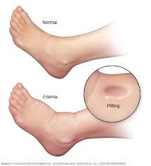 Maybe you would like to learn more about one of these? Edema Sintomas Y Causas Mayo Clinic