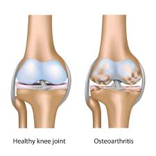 Ini menyebabkan bahagian bawah kaki mengalami kecederaan dan sakit tumit. Sakit Lutut Punca Simptom Dan Rawatan Fisioterapi Ifix Physiotherapy