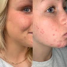 This beautiful client had a break out while attending her first semester at  college. This can happen with diet changes, stress and lack of sleep. We  can do a few simple steps