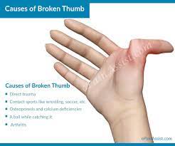 Underneath the post other teens have posted pictures of their own broken thumbs in a hall of horrors. Pin By Kai Gower On Gross Sports Injury Finger Injury Broken Thumb