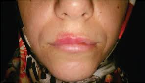 Image result for syphilis ulcer