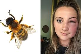 Here's what happens if you get stung by a bee near your eye