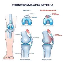Image result for Patella Mobility Test