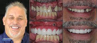 Dental health is one of the crucial aspects of health for any living being. All On 4 Dental Implants Tennessee Family Dental Nashville Tn Dentist