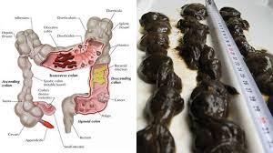 Epingle Par Marc De Mulder Sur Sante Degonfler Ventre Sante Nettoyer Colon