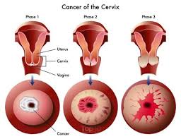 Image result for Colposcopy