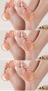 Calos Nos Pés Olho De Peixe Veja Como Eliminar Os Calos Nos Pes Manicure Health Health Fitness