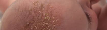 Image result for white scabs on the head in children