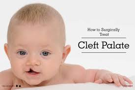 How to Surgically Treat Cleft Palate
