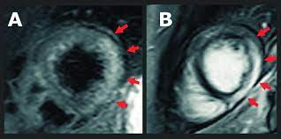 Otros signos y síntomas de una infección viral, como dolor de cabeza, dolores corporales, dolor en las articulaciones, fiebre, dolor de garganta o diarrea. Miocarditis Aguda Diagnosticada Con Cardiorresonancia Magnetica A Se Download Scientific Diagram