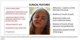 Bell's palsy can strike anyone at any age. The Droopy Dribbler Paediatric Presentations Of Bell S Palsy Rcemlearning