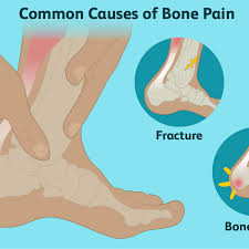While bone pain is the main symptom of bone cancer, and pain in the hip bone can be an indication of a tumor in the hip, there are often more likely other explanations for hip pain. Bone Pain Causes Treatment And When To See A Doctor