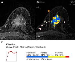 A pet/ct scan is a newer technology used to create images of the body's cells as they work. Plos One Preoperative Dynamic Breast Magnetic Resonance Imaging Kinetic Features Using Computer Aided Diagnosis Association With Survival Outcome And Tumor Aggressiveness In Patients With Invasive Breast Cancer