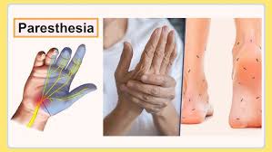 Image result for Paresthesia
