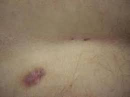 Image result for Pilonidal Cyst